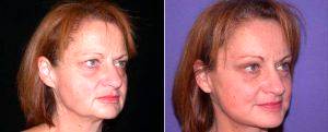 Browlift, Facelift, Blepharoplasty By Doctor Shahram Salemy, MD, FACS, Seattle Plastic Surgeon