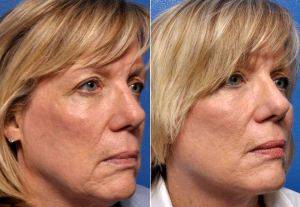 Cheek Enhancement, Jawline Definition, And Neck Band Improvement With Face And Neck Lift With Doctor Kian Karimi, MD, FACS, Los Angeles Facial Plastic Surgeon