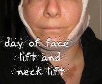 Day Of Face Lift