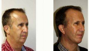Doctor Boris M. Ackerman, MD, Newport Beach Plastic Surgeon - 46 Year Old Man Treated With Facelift