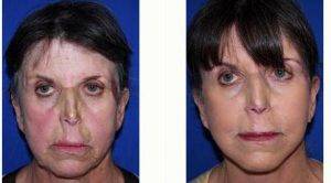Doctor Carlos Mata, MD, MBA, FACS, Scottsdale Plastic Surgeon - 64 Year Old Woman Treated With Facelift