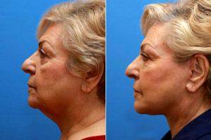 Doctor Frank P. Fechner, MD, Worcester Facial Plastic Surgeon - Face And Neck Lift With Facial Fat Injections