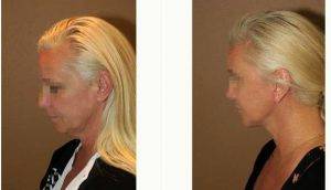 Doctor Gregory Turowski, MD, PhD, FACS, Chicago Plastic Surgeon - 53 Year Old Woman Treated With Facelift