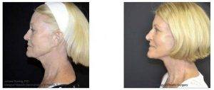 Doctor James H. Rosing, MD, Newport Beach Plastic Surgeon - 76 Year Old Woman Treated With A Facelift