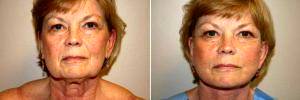 Doctor Jeffrey M. Darrow, MD, Boston Plastic Surgeon - Facelift With SMASectomy