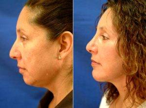Doctor Juris Bunkis, MD, FACS, Newport Beach Plastic Surgeon - 45 Year Old Woman Treated With Facelift