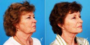 Doctor Justin West, MD, Newport Beach Plastic Surgeon - 62 Year Old Woman Receives Facelift And Neck Lift