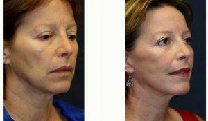 Doctor Kris M. Reddy, MD, FACS, West Palm Beach Plastic Surgeon - 52 Year Old Woman Treated With Facelift