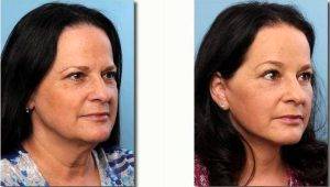 Doctor Mark Gaon, MD - Newport Beach Plastic Surgeon - 59 Year Old Woman Treated With Facelift