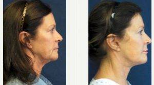 Doctor Marshall T. Partington, MD, FACS, Seattle Plastic Surgeon - 56 Year Old Woman Treated With Facelift