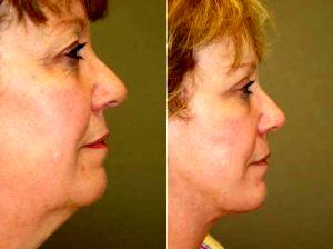Doctor Michael A. Epstein, MD, FACS, Chicago Plastic Surgeon - Facelift, Liposuction Of The Neck, Upper Eyelid Lift