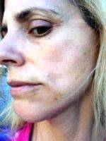 Doctor Michael C. Fasching Smas Facelift Results