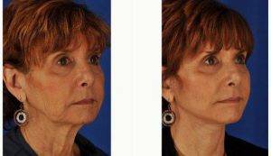 Doctor Peter D. Geldner, MD, Chicago Plastic Surgeon - 62 Year-old Woman Desired Facelift And Open Necklift