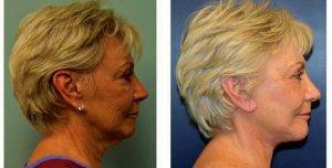 Doctor Richard G. Reish, MD, New York Plastic Surgeon - 65 Year Old Woman Treated With Facelift