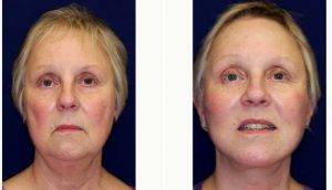 Doctor Robert J .Paresi Jr., MD, MPH, Chicago Plastic Surgeon - 55 Year Old Woman Treated With Facelift