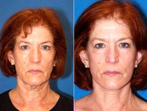 Doctor Ross A. Clevens, MD, Melbourne Facial Plastic Surgeon - Facelift