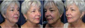 Doctor Scott C. Sattler, MD, FACS, Seattle Plastic Surgeon - 60 Year Old Woman Treated With Facelift
