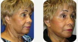 Doctor Stephen Fink, DO FAOCO, Newport Beach Facial Plastic Surgeon - 61 Year Old Woman Treated With Facelift