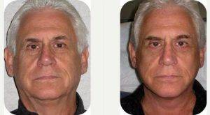 Doctor Stephen Fink, DO FAOCO, Newport Beach Facial Plastic Surgeon - Male Patient Had A Face An Neck Lift With Lower Eye Lids