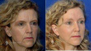 Doctor Warwick Nettle, MBBS, FRACS, Sydney Plastic Surgeon - 61 Year Old Woman Treated With Facelift