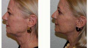 Dr Anand G. Shah, MD, San Antonio Facial Plastic Surgeon - 57 Year Old Woman Treated With Facelift