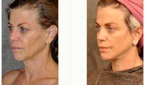 Dr Ben Talei, MD, Beverly Hills Facial Plastic Surgeon - 53 Year Old Woman Treated With Facelift