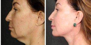 Dr Chia Chi Kao, MD, Los Angeles Plastic Surgeon - 59 Year Old Woman Treated With Ponytail Facelift