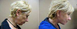 Dr David Shifrin, MD, Chicago Plastic Surgeon - 54 Year Old Woman Treated For Facial Aging