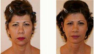 Dr Dino R. Elyassnia, MD, San Francisco Plastic Surgeon - 52 Year Old Woman Treated With Facelift