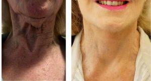 Dr Elena Prousskaia Peregudova, FRCS (Plast), London Plastic Surgeon - 75 And Up Year Old Woman Treated With Facelift