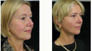 Dr George Volpe, MD, Newton Plastic Surgeon - Facelift