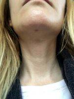 Dr Grant Stevens Face Lifting With Neck Lift