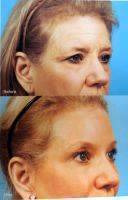 Dr Gwen Maxwell Mini Facelift Results