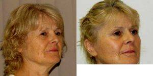 Dr Ivo Gwanmesia, FRCS(Plast), London Plastic Surgeon - 62 Year Old Woman Treated With Facelift
