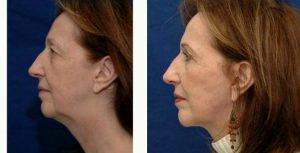 Dr Jeffrey Ditesheim, MD, FACS, Charlotte Plastic Surgeon - 56 Year Old Woman Treated With Facelift