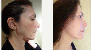 Dr Joseph M. Pober, MD, FACS, New York Plastic Surgeon - 47 Year Old Woman Treated With Facelift