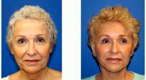 Dr Kara K. Criswell, MD, FACS, Charlotte Plastic Surgeon - 66 Year Old Woman Treated With Facelift