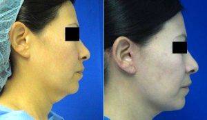 Dr Kenneth B. Hughes, MD, Los Angeles Plastic Surgeon - Female Lower Face And Neck Lift