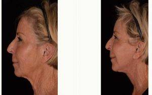 Dr Kian Karimi, MD, FACS, Los Angeles Facial Plastic Surgeon - Complete Rejuvenation After Lower Face And Neck Lift