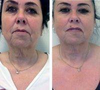 Dr Konstantin Vasyukevich Plastic Surgery Face Lift Before And After