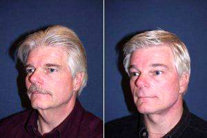 Dr M. Sean Freeman, MD, Charlotte Facial Plastic Surgeon - 62 Year Old Male With Facelift And Brow Lift