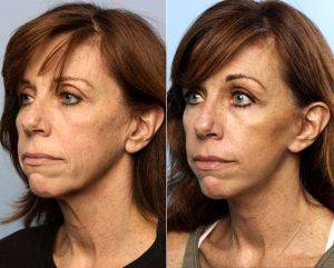 Dr Mark Gaon, MD - Newport Beach Plastic Surgeon - 55 Year Old Woman Treated With Facelift