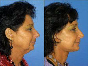 Dr Philip J. Miller, MD, FACS, New York Facial Plastic Surgeon - Facelift, Chin Implant