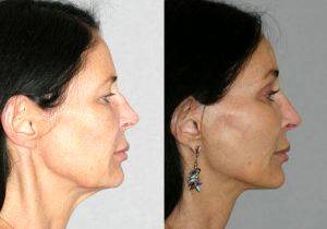 Dr Ramin Behmand, MD, San Francisco Plastic Surgeon - Face And Neck Lift