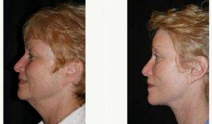 Dr Randal Haworth, MD, FACS, Los Angeles Plastic Surgeon - 63 Year Old Woman Treated With Facelift