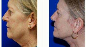Dr. Anand G. Shah, MD, San Antonio Facial Plastic Surgeon - 50 Year Old Woman Treated With Facelift