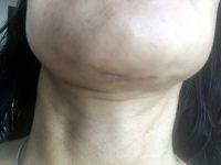 Dr. Anil R. Shah Facial Plastic Surgery Result Image
