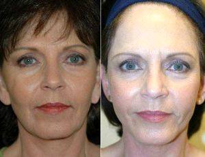 Dr. Catherine T. Milbourn, MD, FACS , San Antonio Plastic Surgeon - Facelift With Earlobe Reduction Before And After