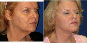 Dr. Dilip D. Madnani, MD, FACS, New York Facial Plastic Surgeon - 68 Year Old Woman Treated With Facelift