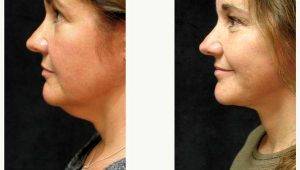 Dr. George Volpe, MD, Newton Plastic Surgeon - Facelift Addressing Neck Concerns